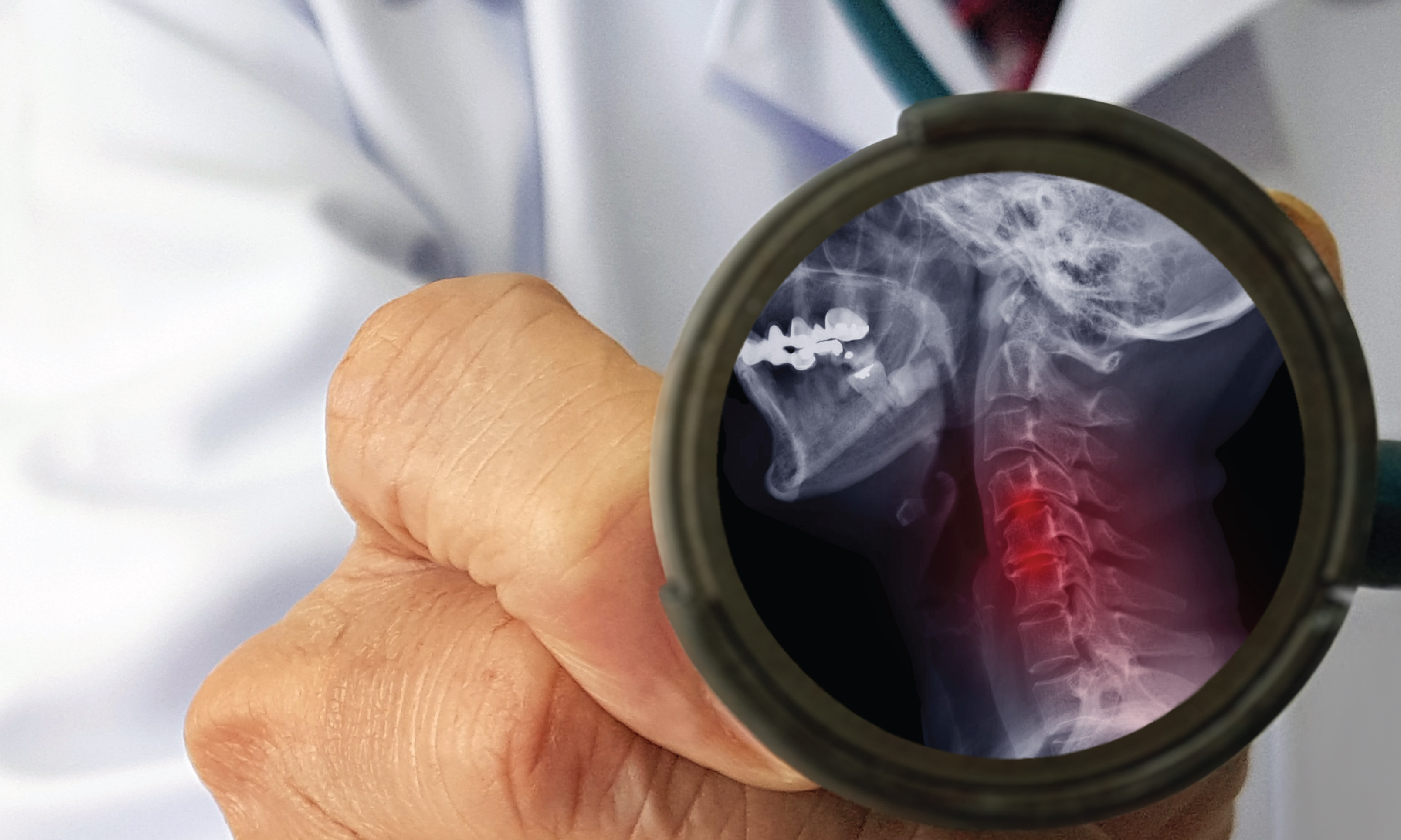 Understanding Cervical Spondylosis