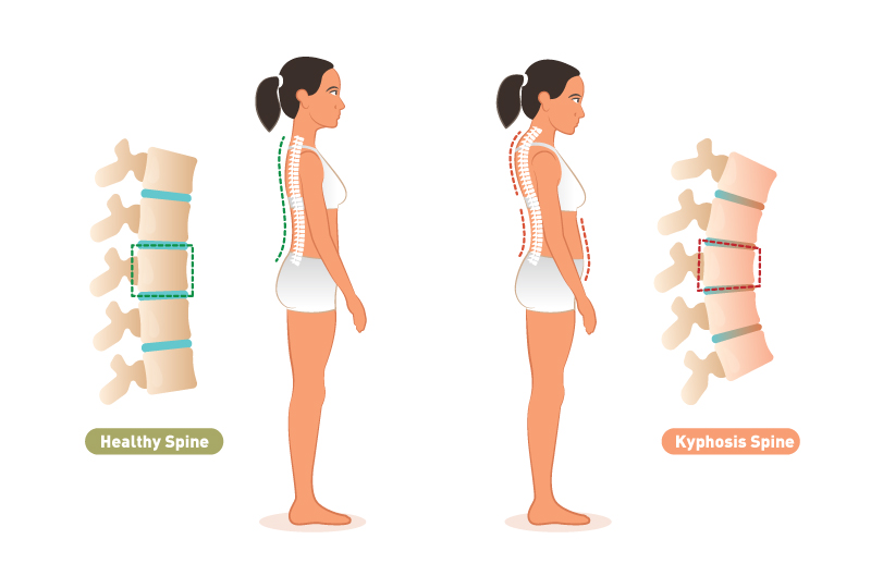 Kyphosis Treatment Causes & Diagnosis