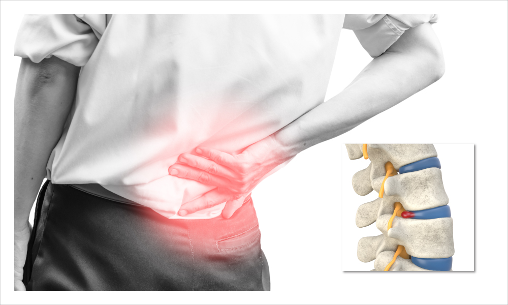 Slipped Disc | Symptoms | Treatment