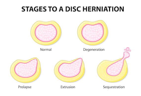 Blog Image - Slipped Disc patients can now prevent surgery
