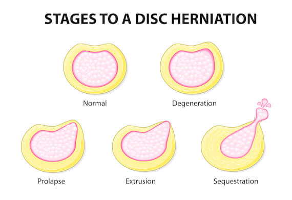 Slipped Disc patients can now prevent surgery