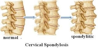 cervical spondylosis