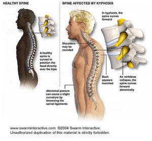 understanding kyphosis