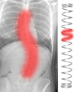 Scoliosis-1