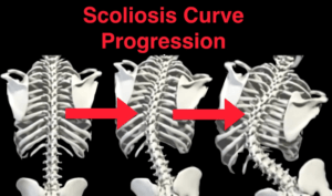 Scoliosis-2