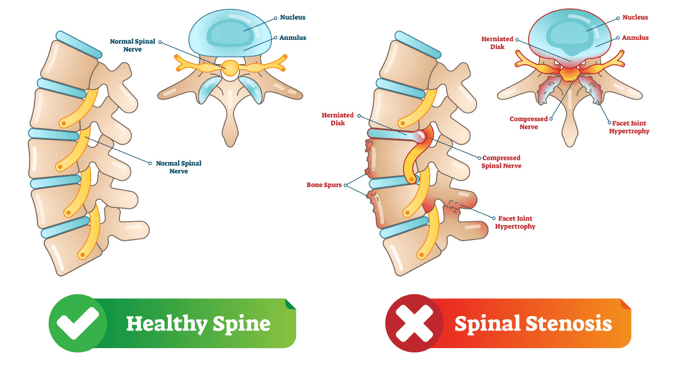 Condition - Cervical Spine Canal Stenosis Treatment