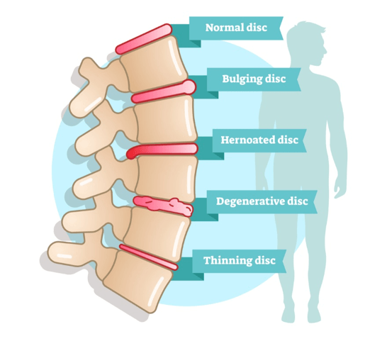 Bulging Disc Treatment: Know Bulging Disc Treatment & Exercises | QI Spine