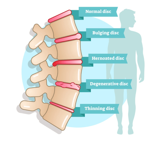 Bulging Disc Treatment: Know Bulging Disc Treatment & Exercises