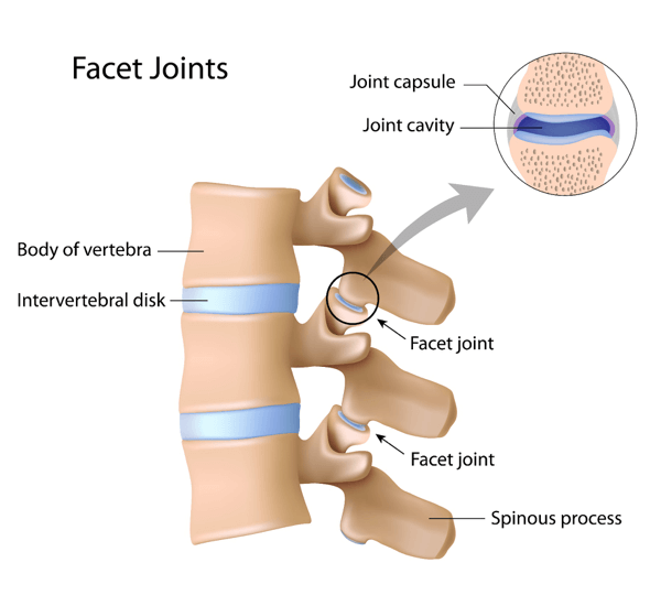 Facet Joint Arthropathy Diagnosis, Treatment & Cure at QI Spine Clinic