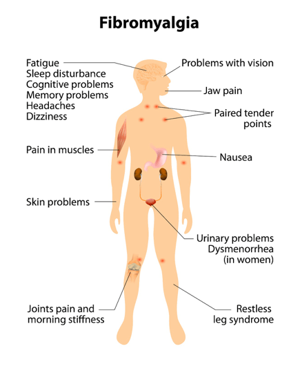 TENS Reduces Pain and Fatigue of Fibromyalgia