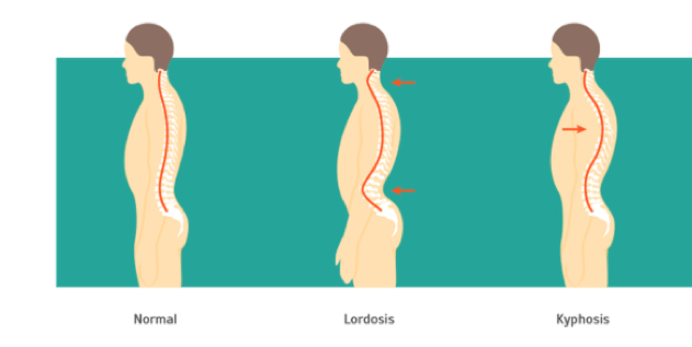 Kyphosis Diagnosis, Treatment & Cure at QI Spine Clinic