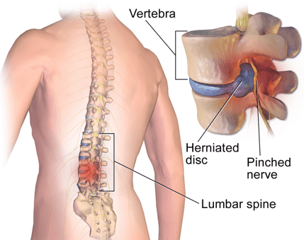 Lumbar Fracture Fixation - Lower Back - Surgery - What We Treat 