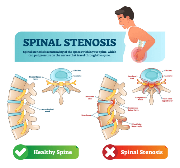 Spinal Canal Stenosis Treatment, Symptoms & Causes