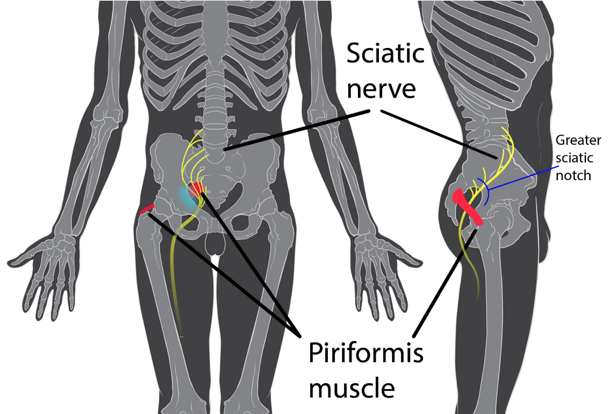 Piriformis Syndrome Treatment - QI Spine Clinic