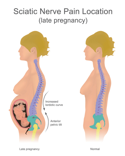 Back pain in pregnancy - NHS