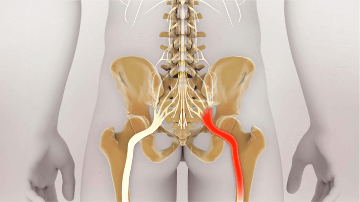 Sciatica Causes, Symptoms, and Treatment