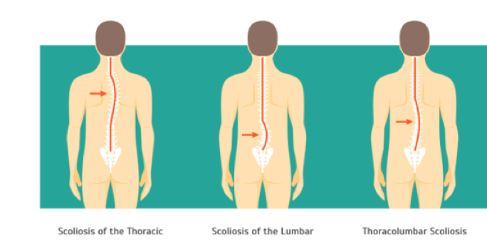 Scoliosis of the Spine: Causes, Symptoms & Treatment