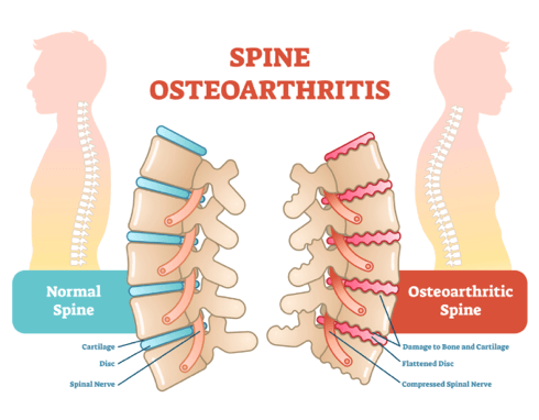 Spinal Arthritis - Degeneration of Bone and Cartilage of Spine