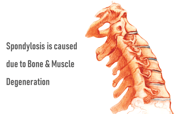 Condition Spondylosis