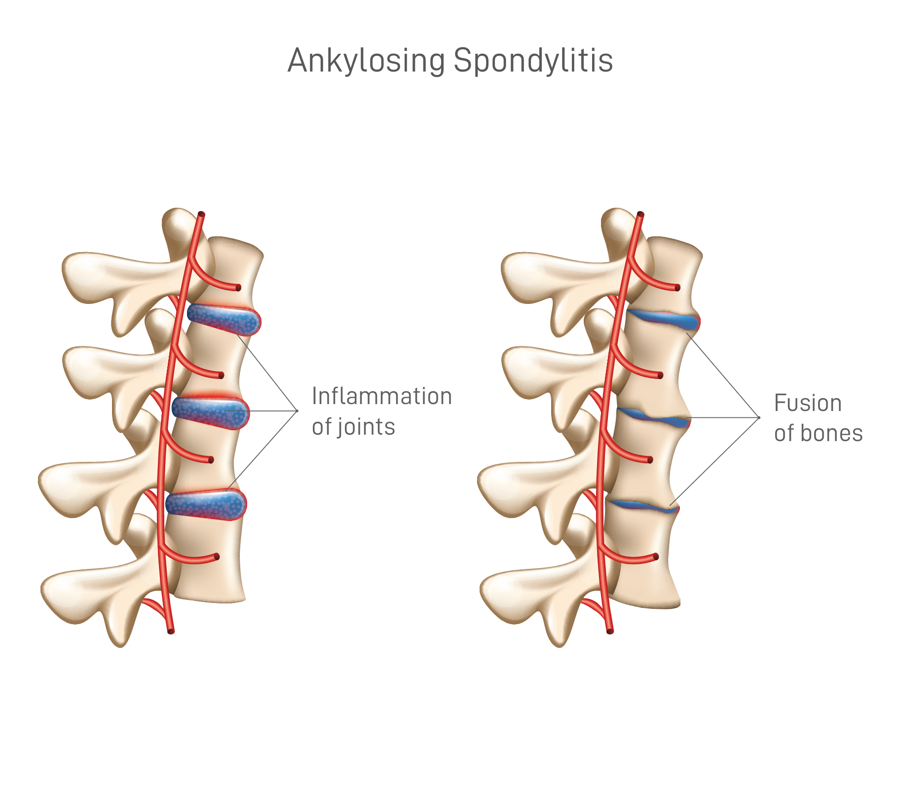 Ankylosing Spondylitis