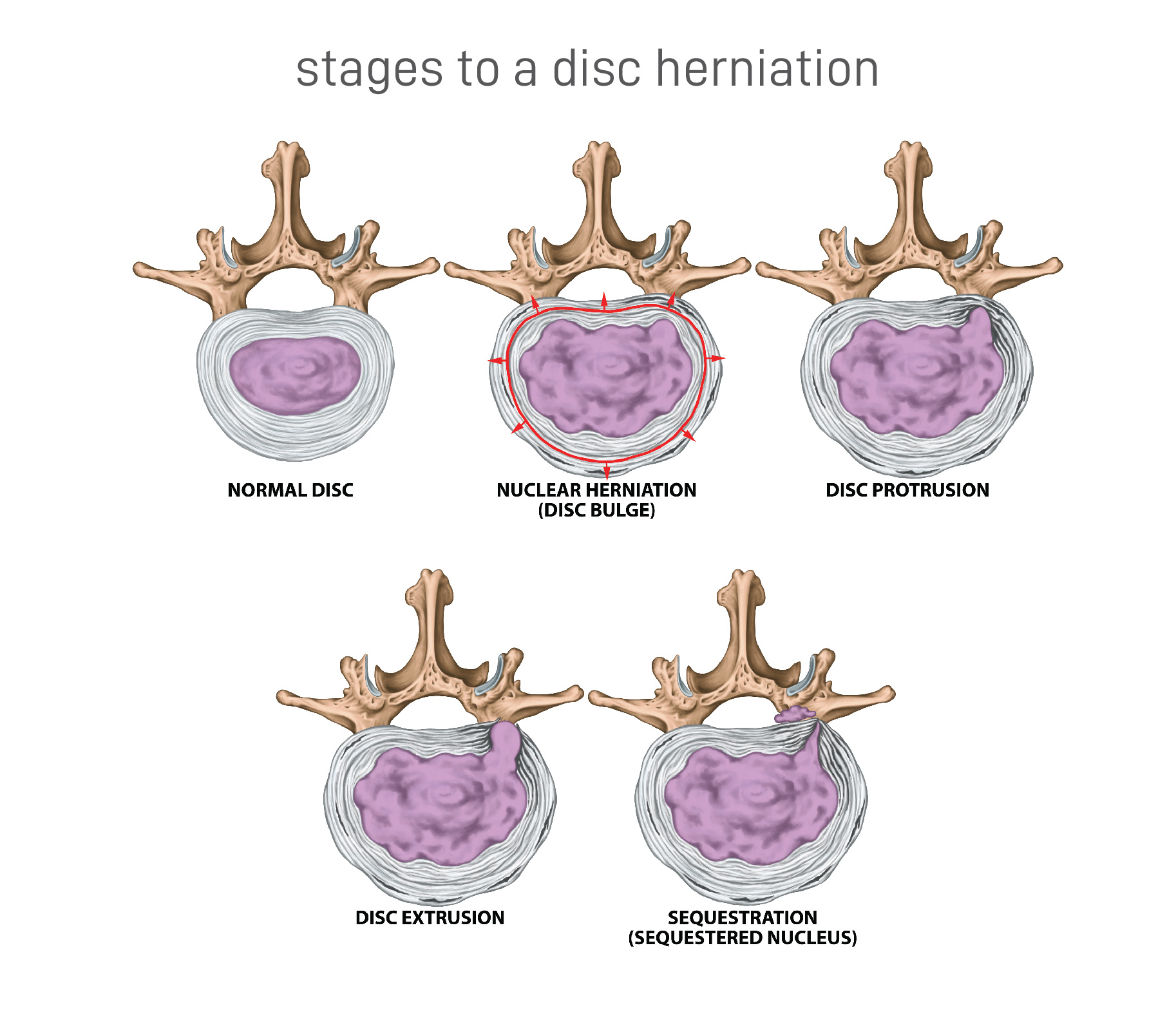 Disc Sequestration - Causes & Treatment