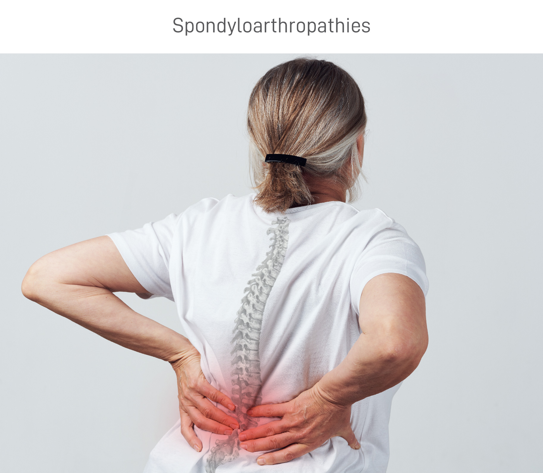 Spondyloarthropathies Pain