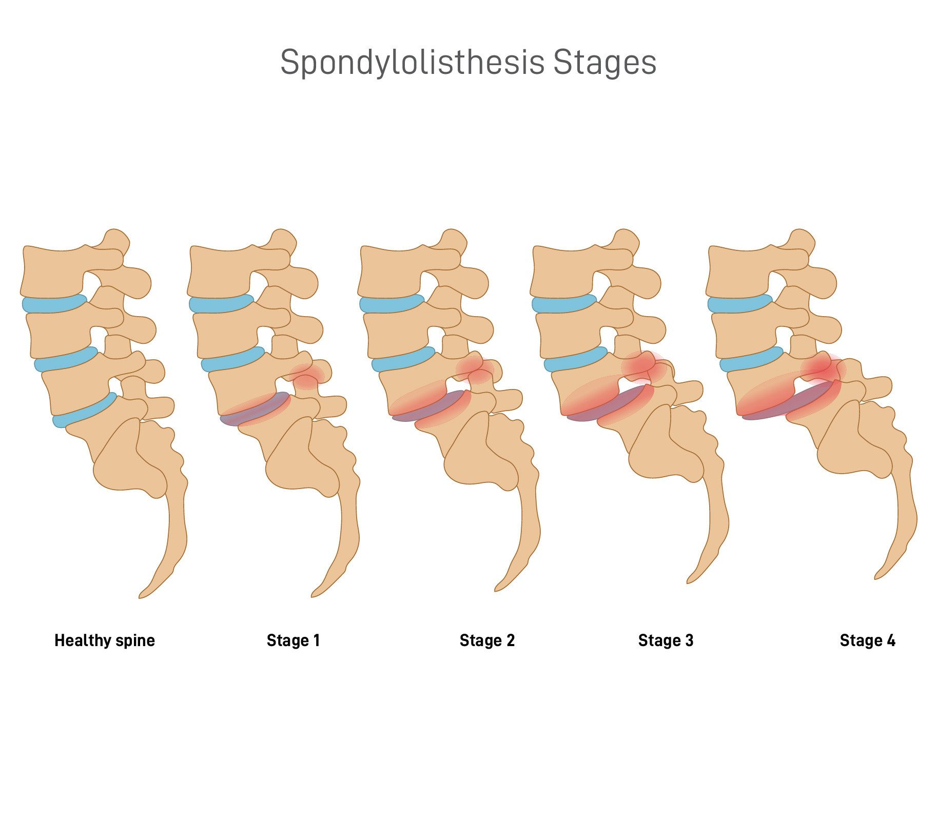 Stages of Spondylolisthesis