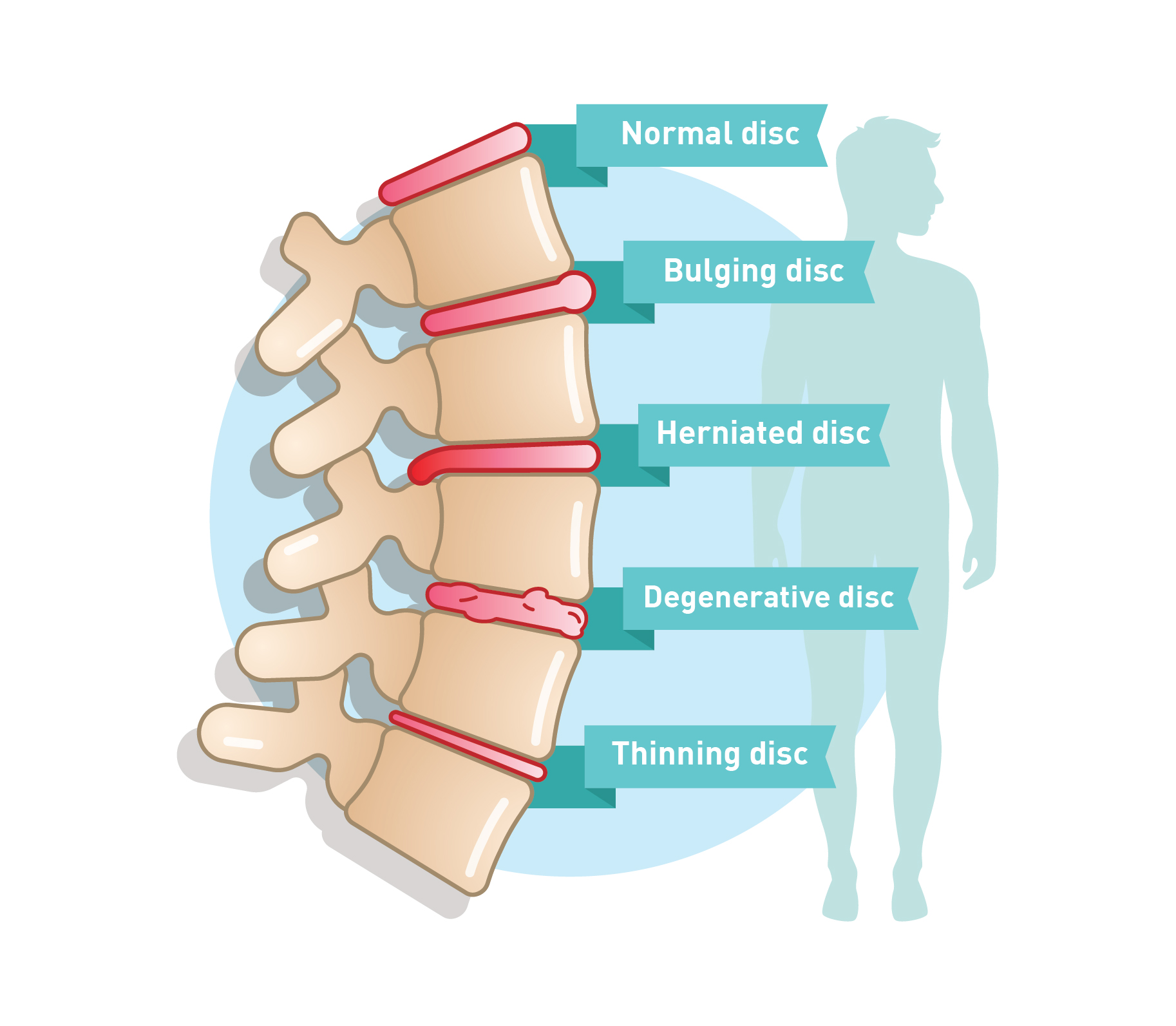 Degenerative Disc Disease Treatment Causes And Symptoms Qi Spine