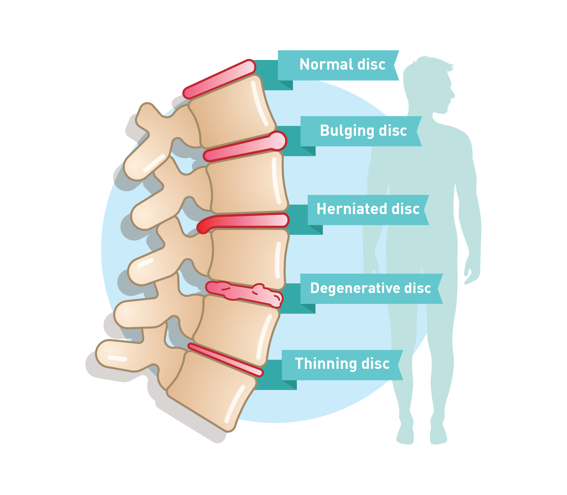 Lumbar Herniated Disc X Ray