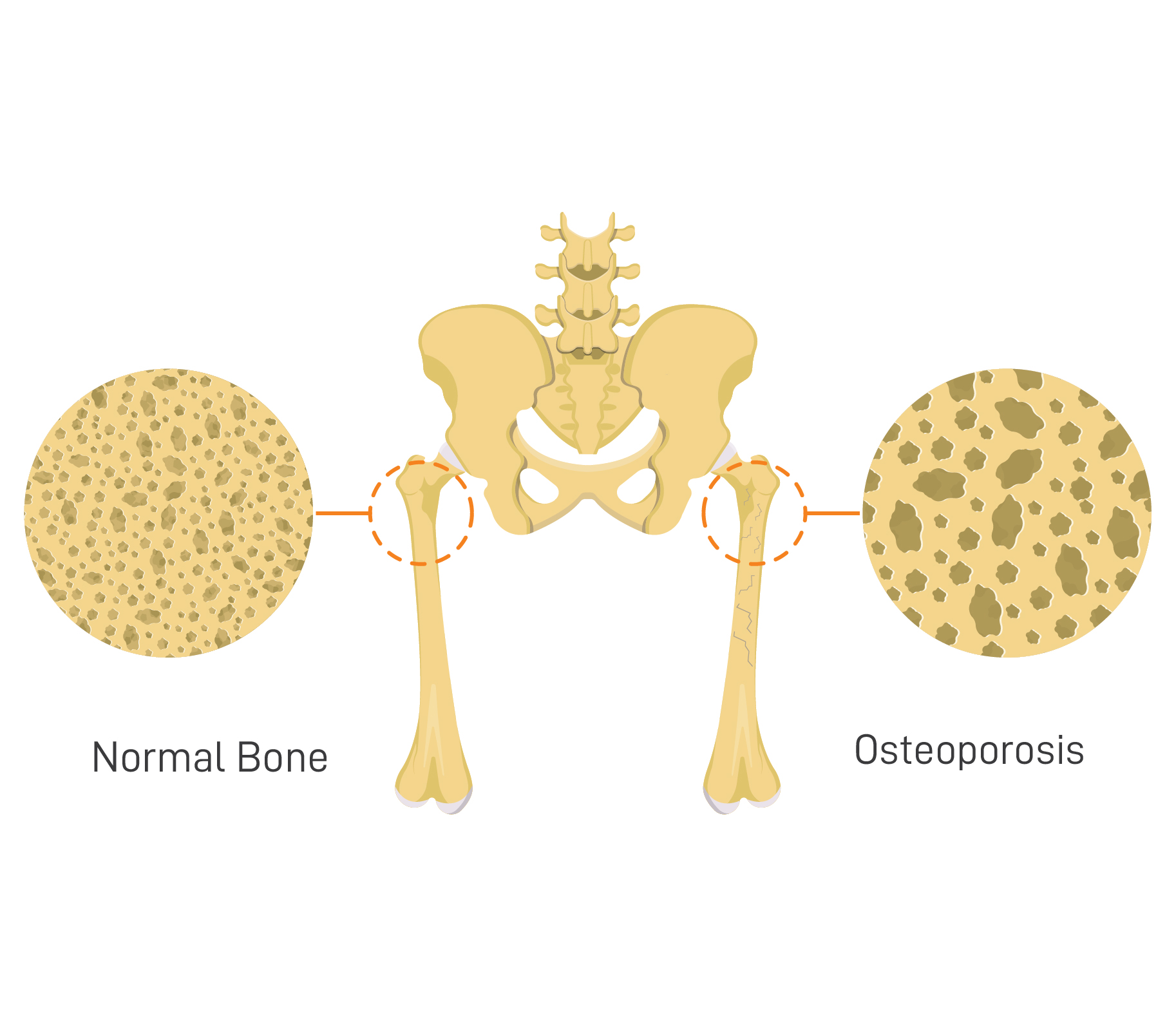 Osteoporosis Bone Causes and Treatment
