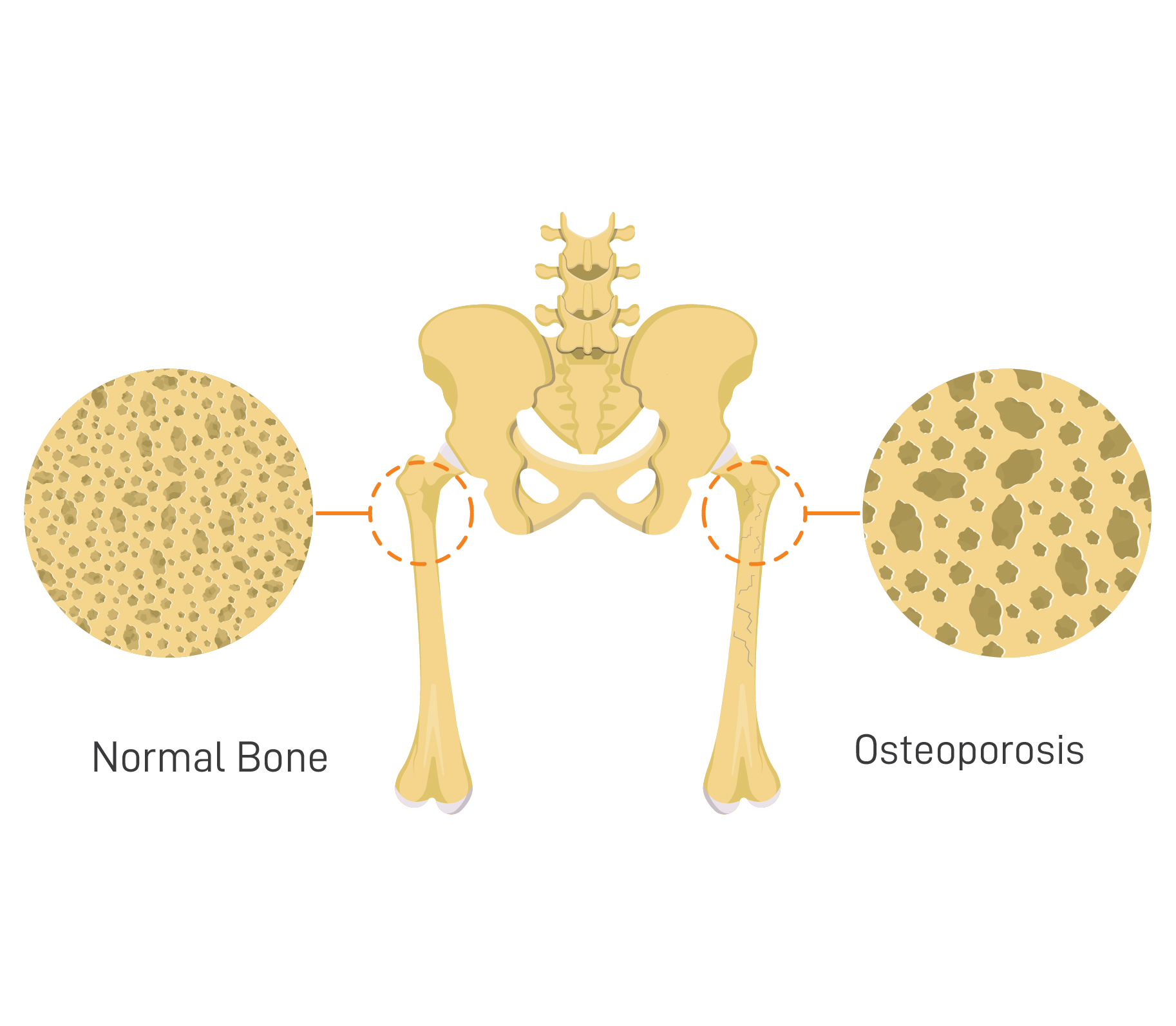 Osteoporosis: Symptoms, Causes and Treatment