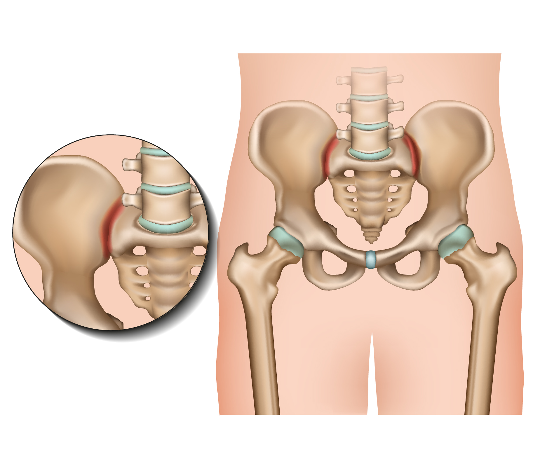 Pelvic Girdle Pain: Causes, Symptoms & Treatment at QI Spine