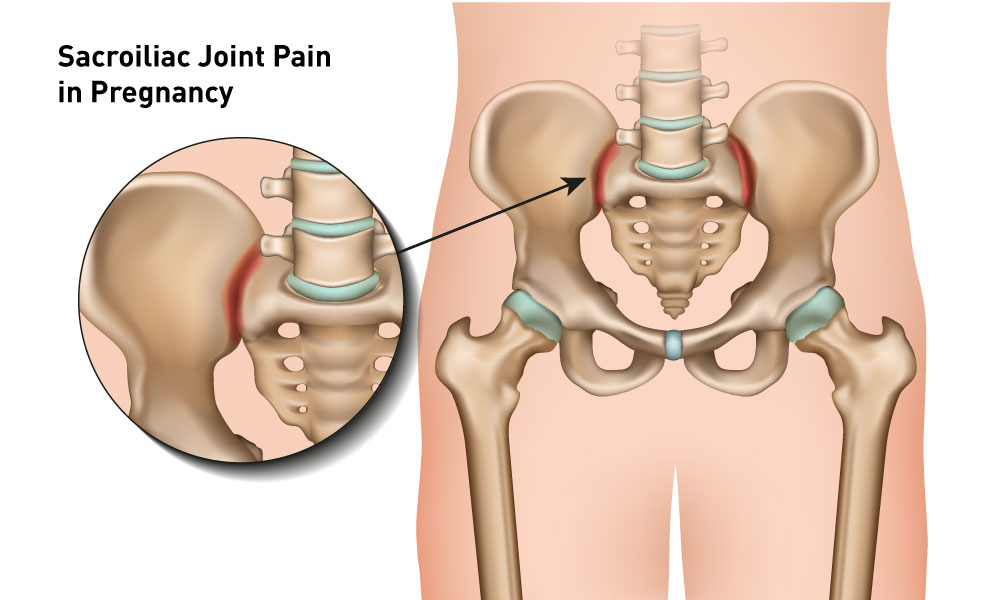 All you need to know about Sacroiliac joint pain during pregnancy & its relief measures