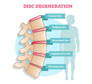 Bulging disc or Slipped disc