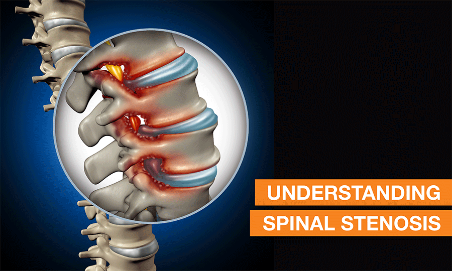 Understanding Spinal Stenosis