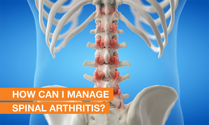 How can I manage spinal arthritis?