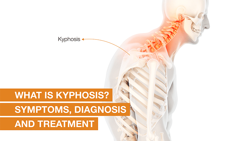 Understanding Kyphosis