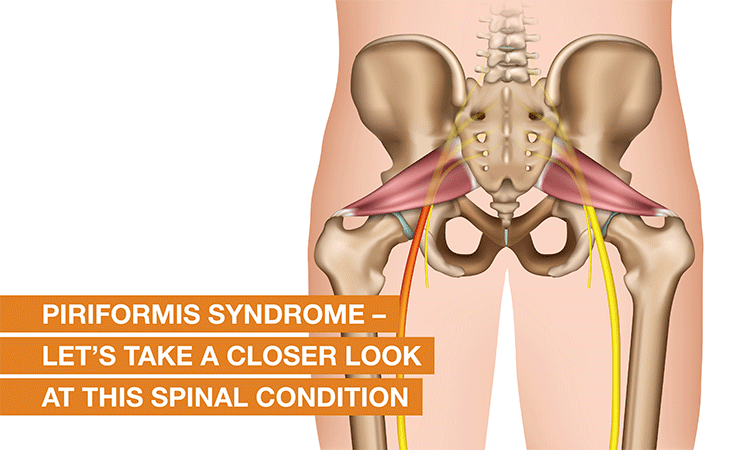 Piriformis Syndrome Symptoms, Diagnosis and Treatments