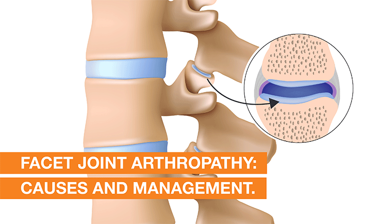 Facet Joint Arthropathy: Causes and Management