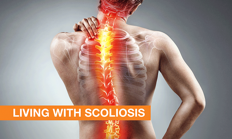 Living with Scoliosis